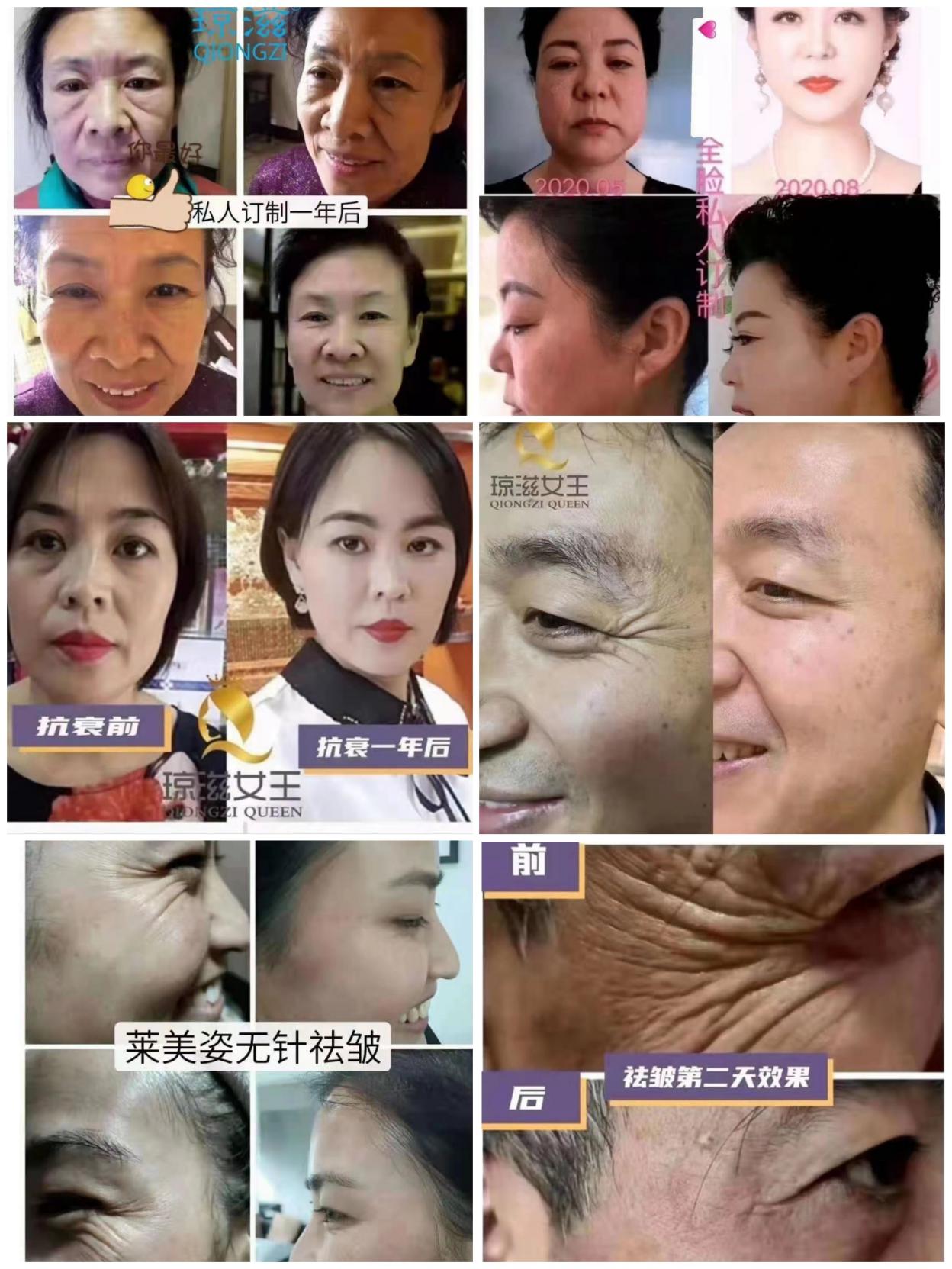 莱美姿琼滋女王祛皱安全吗见效快吗能维持多久