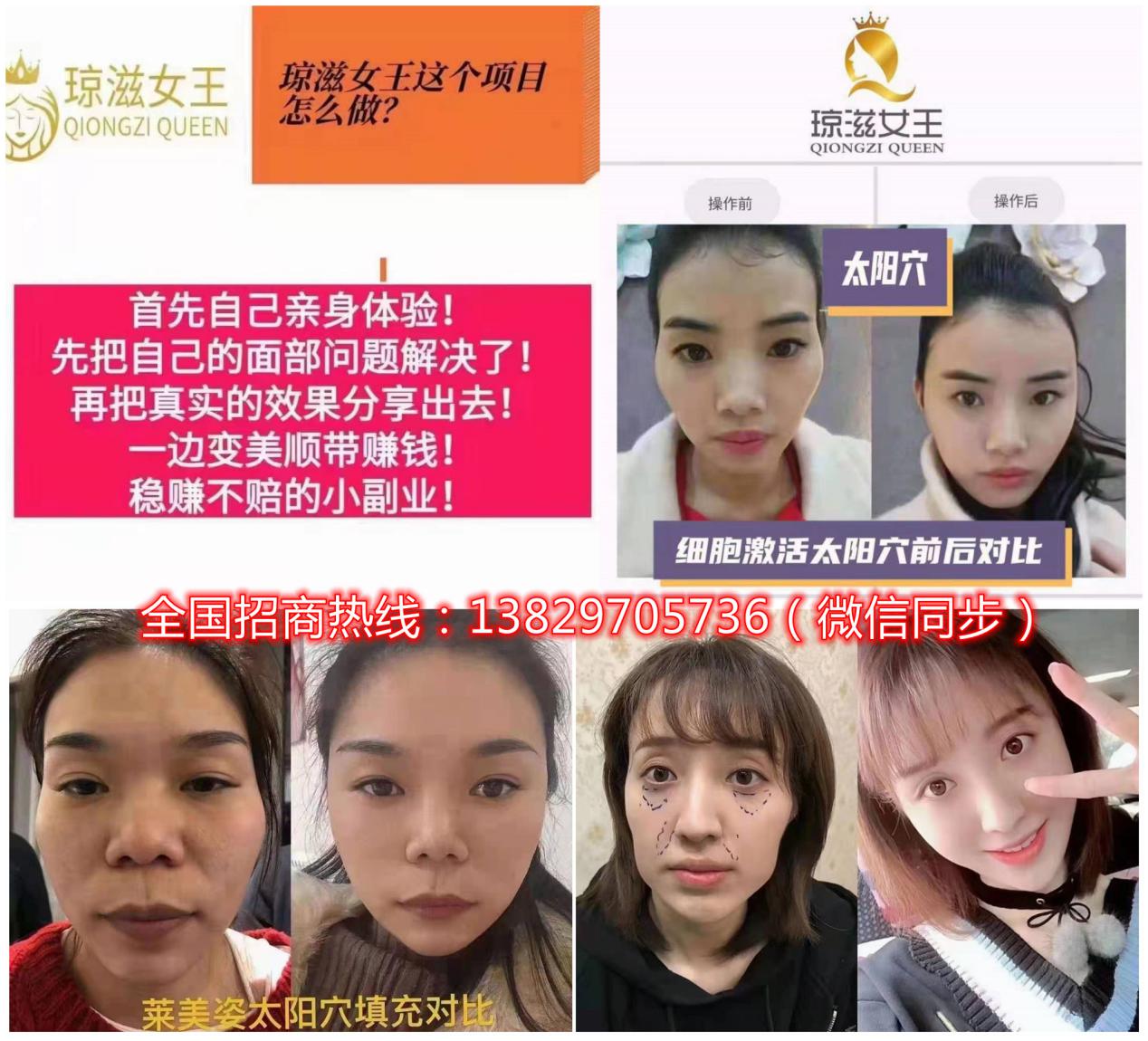 琼滋女王皱有什么加盟条件代理收益怎么样比其它医美高吗